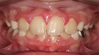 After orthodontic treatment