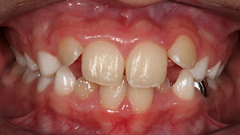 Before orthodontic treatment