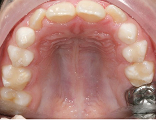 Before smile correction