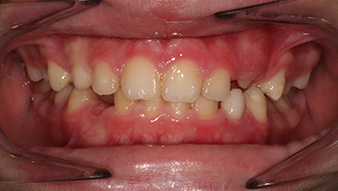 After orthodontic treatment