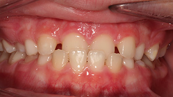 Before orthodontic treatment