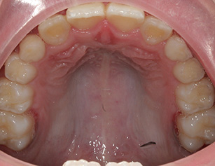 Smile after treatment