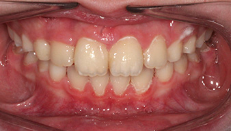 After orthodontic care