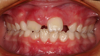 Before treatment smile